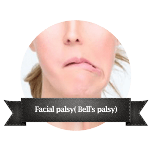 Facial palsy( Bell’s palsy)
