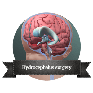 Hydrocephalus surgery